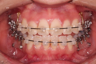부산교정잘하는치과