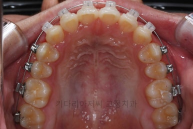 연산동치아교정