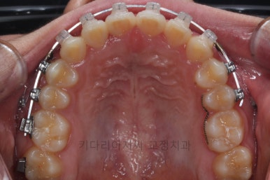 연산동치아교정