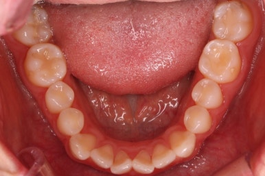 부산나비앞니교정