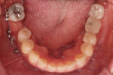 연산동부분교정