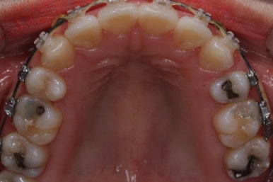 부산연산동교정치과