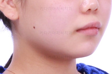 부산앞니벌어짐교정