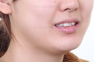 부산안면비대칭