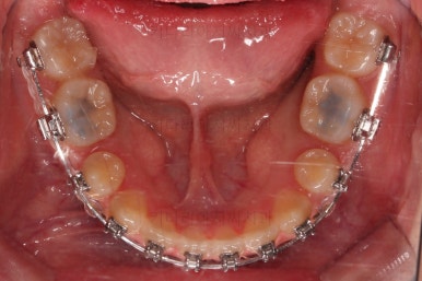 동래구치아교정