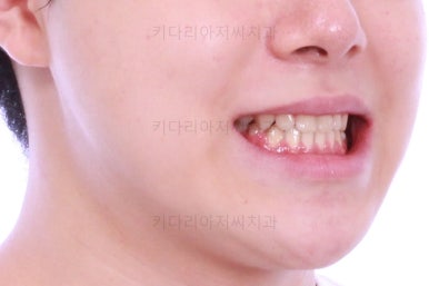 부산주걱턱교정