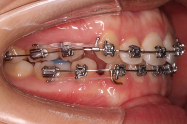 사직동교정치과