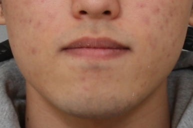 부산주걱턱교정