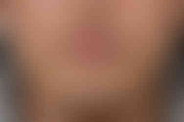 부산주걱턱교정