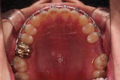 연산동임플란트