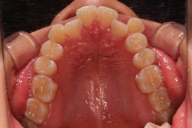 부산비발치교정