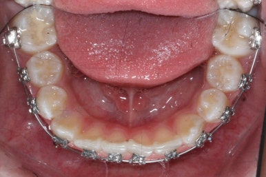 연산동덧니교정