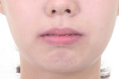 부산치아교정잘하는치과