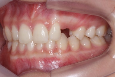 부산매복치아교정