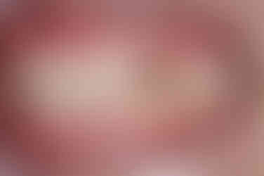 부산매복치아교정