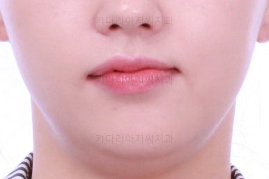 부산비대칭교정