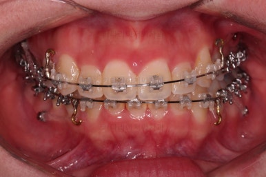 부산비대칭교정