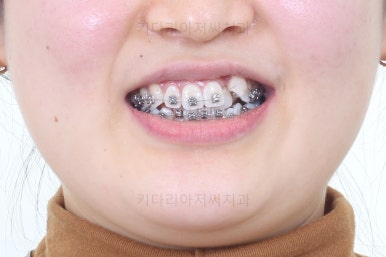 부산치아교정