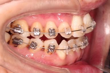 부산구순구개열교정
