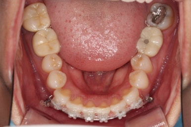 부산부분치아교정