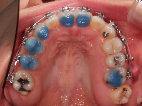 부산임플란트교정