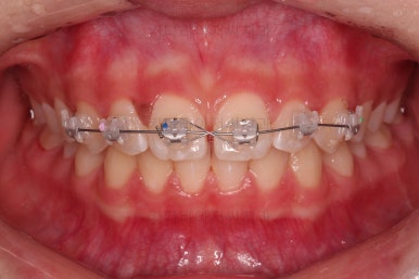 부산앞니벌어짐교정