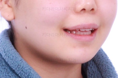 부산앞니벌어짐교정