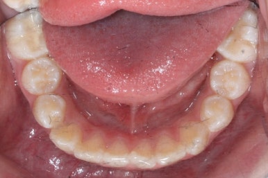 연산동덧니교정