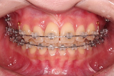 부산돌출입교정