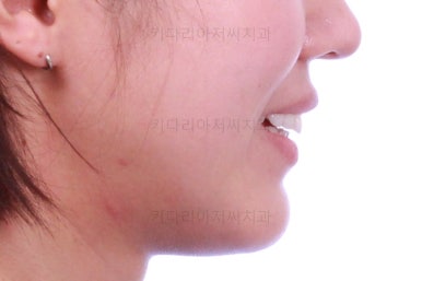 부산치아교정잘하는곳