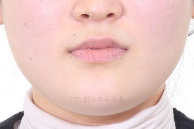 부산치아교정