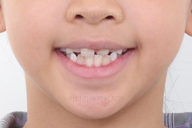 부산어린이반대교합