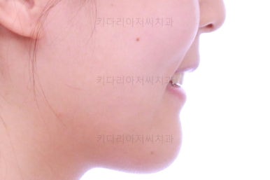 부산클리피씨교정