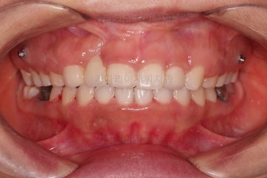 부산구순구개열