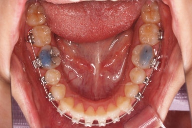 부산비발치교정