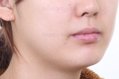 부산안면비대칭