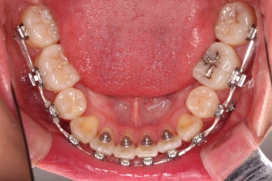 부산치아교정잘하는치과