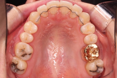 부산치아교정잘하는곳