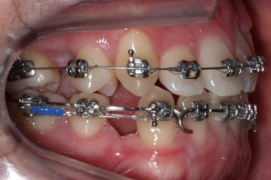 부산구순구개열