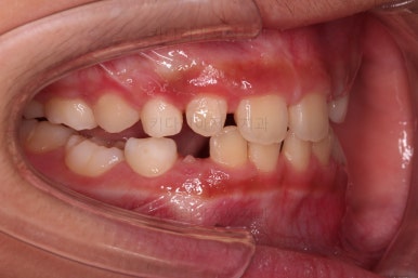 부산어린이돌출입교정