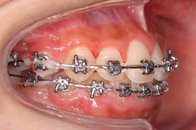 부산비발치교정