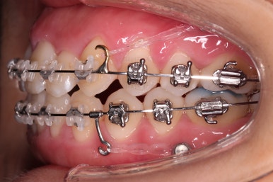 부산비발치교정