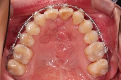 부산구순구개열교정