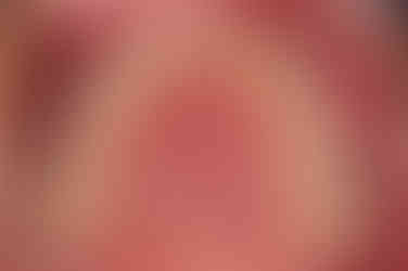 부산구순구개열교정