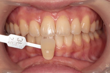 부산돌출입교정