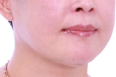 동래임플란트교정