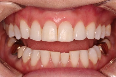 연산동부분교정