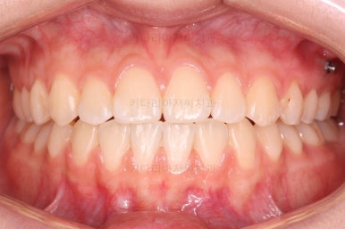 부산치아교정잘하는곳