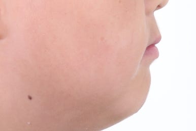 부산비발치교정