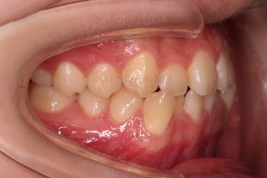 동래구치아교정